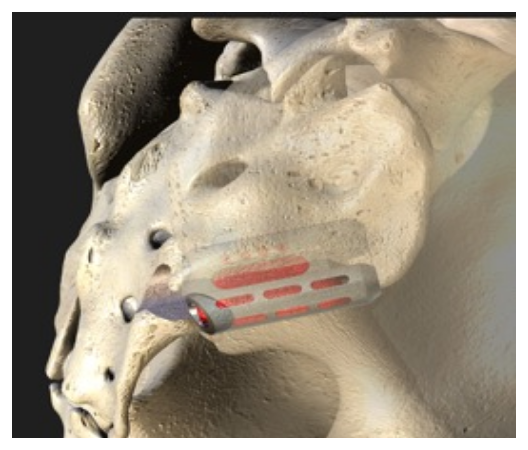 si joint implant