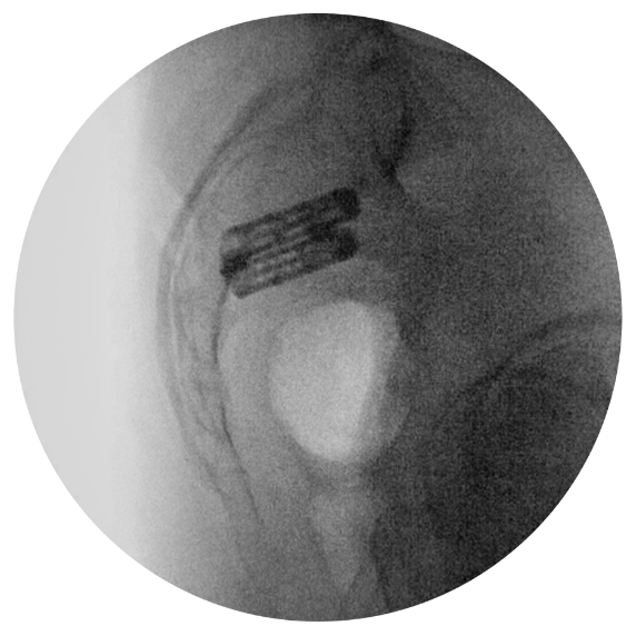 si joint implant lateral view