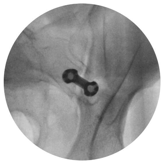 si joint implant modified inlet view