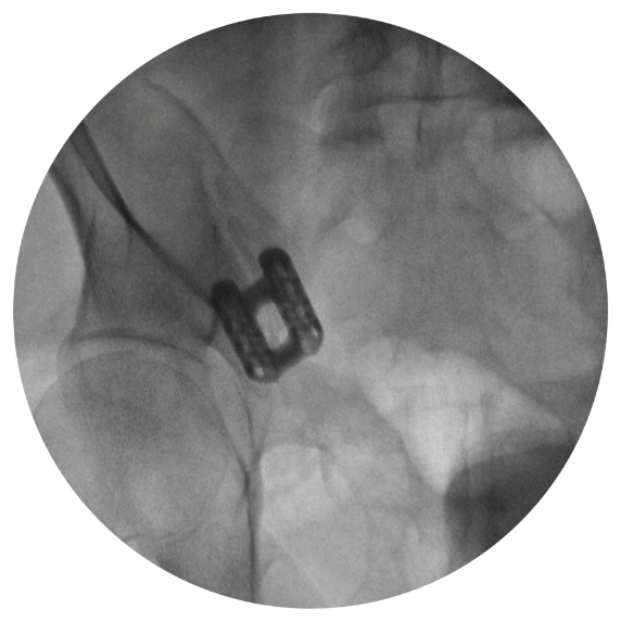 si joint implant modified outlet view